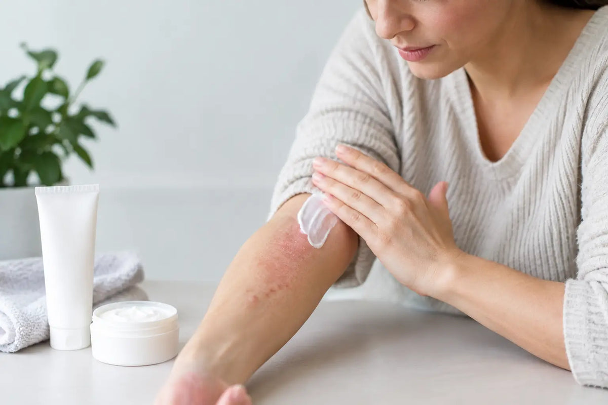 Are Steroid Free Creams Effective for Eczema?