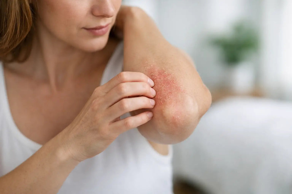 Why Does Eczema Keep Returning? - Loma Lux Laboratories