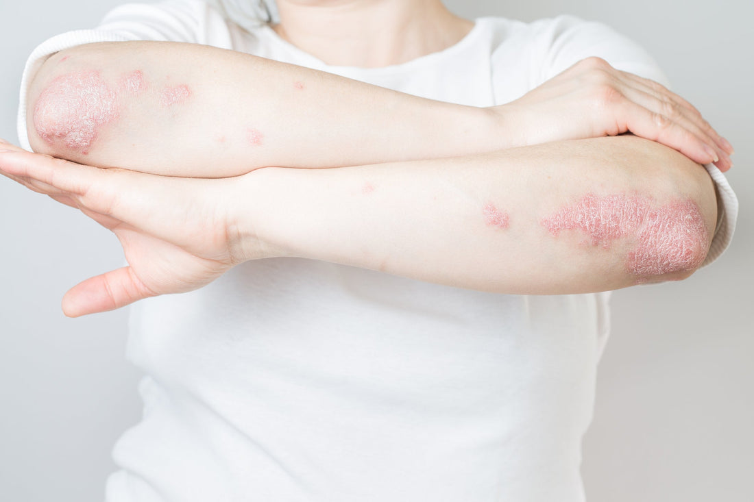 Psoriasis - Loma Lux Laboratories