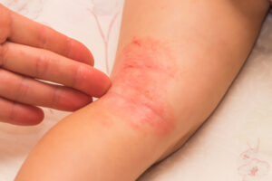 eczema image